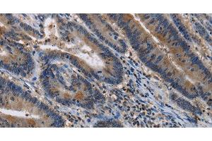 Immunohistochemistry of paraffin-embedded Human colon cancer tissue using ITPR2 Polyclonal Antibody at dilution 1:40 (ITPR2 Antikörper)