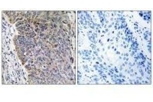 Immunohistochemistry analysis of paraffin-embedded human lung carcinoma tissue using MGST3 antibody. (MGST3 Antikörper)