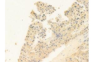 ABIN6258807 and ABIN6273863 at 1/100 staining human hepatocellular carcinoma by IHC-P. (GPR25 Antikörper  (Internal Region))
