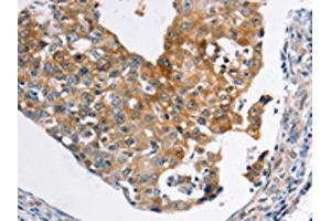 The image on the left is immunohistochemistry of paraffin-embedded Human breast cancer tissue using ABIN7189590(ABCC3 Antibody) at dilution 1/20, on the right is treated with synthetic peptide. (ABCC3 Antikörper)