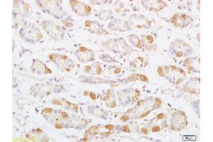 Formalin-fixed and paraffin embedded human colon carcinoma labeled with Anti Phospho-MAP3K8/Tpl2 (Thr290) Polyclonal Antibody, Unconjugated (ABIN746588) at 1:200 followed by conjugation to the secondary antibody and DAB staining (MAP3K8 Antikörper  (pThr290))