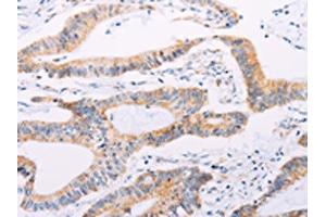 The image on the left is immunohistochemistry of paraffin-embedded Human colon cancer tissue using ABIN7189654(ADAMTS16 Antibody) at dilution 1/50, on the right is treated with synthetic peptide. (ADAMTS16 Antikörper)
