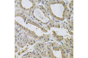 Immunohistochemistry of paraffin-embedded human thyroid cancer using NCF4 Antibody (ABIN1873838) at dilution of 1:100 (40x lens). (NCF4 Antikörper)