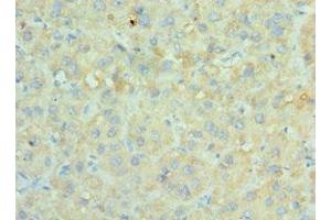 Immunohistochemistry of paraffin-embedded human liver cancer using ABIN7170676 at dilution of 1:100