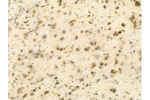 ABIN6256122 and ABIN6267379 at 1/100 staining human melanoma by IHC-P. (Cyclin B1 Antikörper  (pSer126))