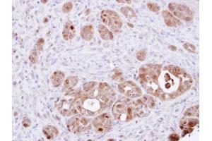 IHC-P Image Immunohistochemical analysis of paraffin-embedded NCIN87 xenograft, using DDT, antibody at 1:100 dilution. (DDT Antikörper)