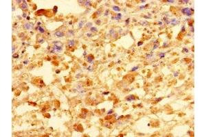 Immunohistochemistry of paraffin-embedded human melanoma using ABIN7148172 at dilution of 1:100 (CCDC91 Antikörper  (AA 1-180))