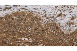 Immunohistochemistry of paraffin-embedded Human cervical cancer tissue using DCTN3 Polyclonal Antibody at dilution 1:70