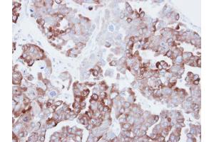 IHC-P Image Immunohistochemical analysis of paraffin-embedded human ovarian carainoma, using Fatty Acid Synthase, antibody at 1:500 dilution.