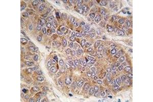 IHC analysis of FFPE human hepatocarcinoma tissue stained with Apolipoprotein A-II antibody (APOA2 Antikörper  (AA 28-56))