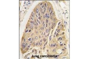 Forlin-fixed and paraffin-embedded hun lung carcino tissue reacted with hP2- antibody, which was peroxidase-conjugated to the secondary antibody, followed by DAB staining. (MAP2 Antikörper  (C-Term))