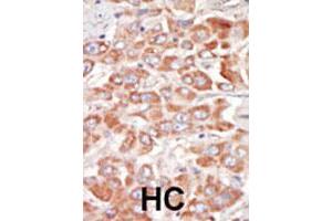 Formalin-fixed and paraffin-embedded human hepatocellular carcinoma tissue reacted with SRPK3 polyclonal antibody  , which was peroxidase-conjugated to the secondary antibody, followed by DAB staining. (SRPK3 Antikörper  (Internal Region))