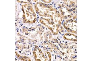 Immunohistochemistry of paraffin-embedded human kidney cancer using FZR1 antibody at dilution of 1:200 (40x lens). (FZR1 Antikörper)