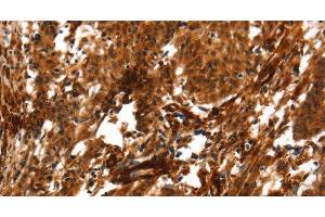 Immunohistochemistry of paraffin-embedded Human gastric cancer using ACTA2 Polyclonal Antibody at dilution of 1:40 (Smooth Muscle Actin Antikörper)