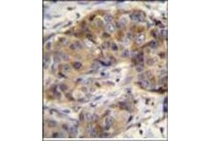 Immunohistochemistry analysis in formalin fixed and paraffin embedded human breast carcinoma reacted with Glutathione reductase Antibody (C-term) followed by peroxidase conjugation of the secondary antibody and DAB staining. (Glutathione Reductase Antikörper  (C-Term))