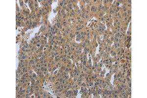 Immunohistochemistry of Human ovarian cancer using PTPRT Polyclonal Antibody at dilution of 1:30