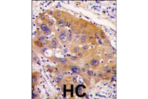 Formalin-fixed and paraffin-embedded human hepatocellular carcinoma reacted with NNMT polyclonal antibody  , which was peroxidase-conjugated to the secondary antibody, followed by DAB staining. (NNMT Antikörper  (AA 77-106))