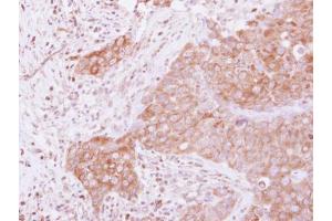 IHC-P Image Immunohistochemical analysis of paraffin-embedded human breast cancer, using GSPT1, antibody at 1:500 dilution. (GSPT1 Antikörper)
