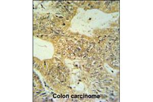 CLDN23 Antibody IHC analysis in formalin fixed and paraffin embedded colon carcinoma followed by peroxidase conjugation of the secondary antibody and DAB staining. (Claudin 23 Antikörper  (C-Term))