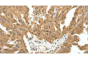 Immunohistochemistry of paraffin-embedded Human ovarian cancer using PTCH1 Polyclonal Antibody at dilution of 1:50 (Patched 1 Antikörper)