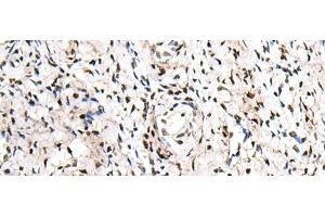 Immunohistochemistry of paraffin-embedded Human cervical cancer tissue using ZNF207 Polyclonal Antibody at dilution of 1:30(x200) (ZNF207 Antikörper)