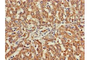 Immunohistochemistry of paraffin-embedded human liver cancer using ABIN7142959 at dilution of 1:100 (CHRNB1 Antikörper  (AA 24-244))