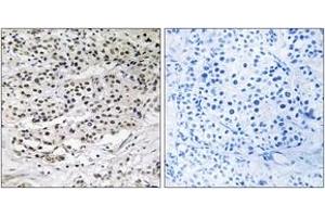 Immunohistochemistry analysis of paraffin-embedded human breast carcinoma tissue, using AZI1 Antibody. (AZI1 Antikörper  (AA 311-360))