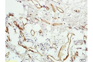 Formalin-fixed and paraffin embedded human colon carcinoma labeled with Rabbit Anti PAR4 Polyclonal Antibody, Unconjugated (ABIN673224) at 1:200 followed by conjugation to the secondary antibody and DAB staining (F2RL3 Antikörper  (AA 320-343))