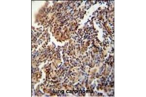 HFM1 antibody (C-term) (ABIN654571 and ABIN2844275) immunohistochemistry analysis in formalin fixed and paraffin embedded human lung carcinoma followed by peroxidase conjugation of the secondary antibody and DAB staining. (HFM1 Antikörper  (C-Term))