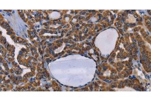 Immunohistochemistry of paraffin-embedded Human thyroid cancer tissue using GRK3 Polyclonal Antibody at dilution 1:50 (ADRBK2 Antikörper)