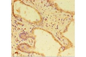 Immunohistochemistry of paraffin-embedded human prostate cancer using ABIN7168303 at dilution of 1:100 (RTF1 Antikörper  (AA 620-670))