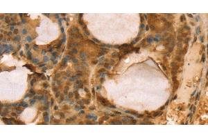 Immunohistochemistry of paraffin-embedded Human thyroid cancer using TAF11 Polyclonal Antibody at dilution of 1:40 (TAF11 Antikörper)