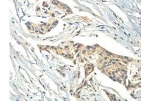Immunohistochemical analysis of paraffin-embedded human breast carcinoma showing cytoplasmic staining with ZC3H11A polyclonal antibody  at a 1 : 100 dilution. (ZC3H11A Antikörper  (AA 332-585))