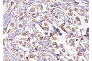 ABIN6277339 at 1/100 staining Human breast cancer tissue by IHC-P.