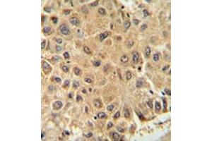Immunohistochemistry analysis in formalin fixed and paraffin embedded human prostate carcinoma reacted with ISCA2 / HBLD1 Antibody (Center) followed which was  peroxidase conjugated to the secondary antibody and followed by DAB staining. (ISCA2 Antikörper  (Middle Region))