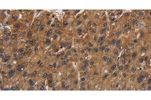 Immunohistochemistry of paraffin-embedded Human gastric cancer using ITGB7 Polyclonal Antibody at dilution of 1:40 (Integrin beta 7 Antikörper)