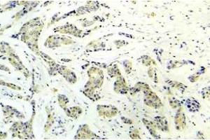 Immunohistochemistry analysis of phospho-PRKAA1 antibody (pSer486) in paraffin-embedded human breast carcinoma tissue.