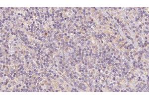 ABIN6273101 at 1/100 staining Human lymph cancer tissue by IHC-P.