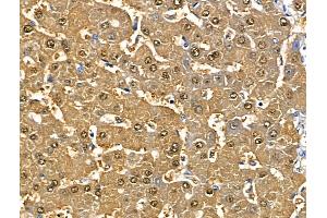 ABIN6265219 and ABIN6268746 at 1/100 staining Human liver cancer and adjacent normal tissues by IHC-P. (SOD1 Antikörper  (Internal Region))