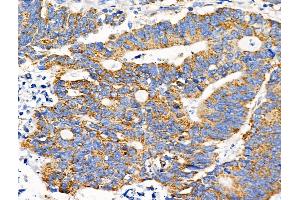 ABIN6258879 and ABIN6274499 at 1/100 staining Human colorectal cancer by IHC-P. (IFIH1 Antikörper  (C-Term))