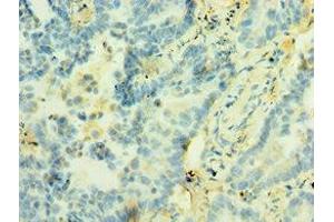 Immunohistochemistry of paraffin-embedded human lung cancer using ABIN7171227 at dilution of 1:100 (Syntaxin 12 Antikörper  (AA 1-250))