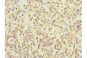 Immunohistochemistry of paraffin-embedded human gastric cancer using ABIN7142352 at dilution of 1:100 (MRPL12 Antikörper  (AA 1-198))