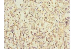 Immunohistochemistry of paraffin-embedded human gastric cancer using ABIN7142352 at dilution of 1:100