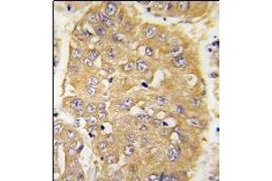 Formalin-fixed and paraffin-embedded human hepatocarcinoma tissue reacted with AP14345PU-N IGFBP3 Antibody (N-term) which was peroxidase-conjugated to the secondary antibody, followed by DAB staining. (IGFBP3 Antikörper  (N-Term))