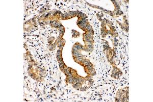 Anti-Integrin alpha 3 antibody, IHC(P) IHC(P): Human Intestinal Cancer Tissue (ITGA3 Antikörper  (N-Term))