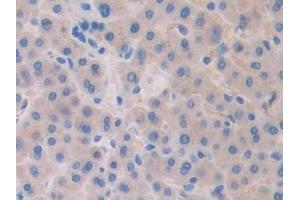 Detection of Slit1 in Human Liver cancer Tissue using Polyclonal Antibody to Slit Homolog 1 (Slit1) (SLIT1 Antikörper  (AA 647-835))