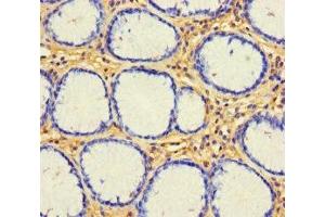 Immunohistochemistry of paraffin-embedded human gastric cancer using ABIN7153143 at dilution of 1:100 (CX3CL1 Antikörper  (AA 25-100))