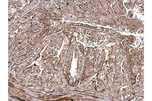 Immunohistochemistry (IHC) image for anti-Matrix Metallopeptidase 1 (Interstitial Collagenase) (MMP1) antibody (ABIN2854783)