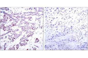 Immunohistochemical analysis of paraffin-embedded human breast carcinoma tissue using STAT6 (phospho-Thr645) antibody (E011051). (STAT6 Antikörper  (pThr645))
