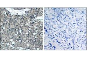 Immunohistochemistry analysis of paraffin-embedded human breast carcinoma tissue, using Paxillin (Ab-118) Antibody. (Paxillin Antikörper  (AA 85-134))